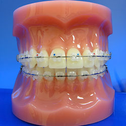 Ceramic Brackets (Clear Braces) - Align Orthodontics : Align