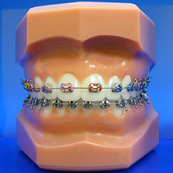 Traditional Metal Braces - Align Orthodontics : Align Orthodontics