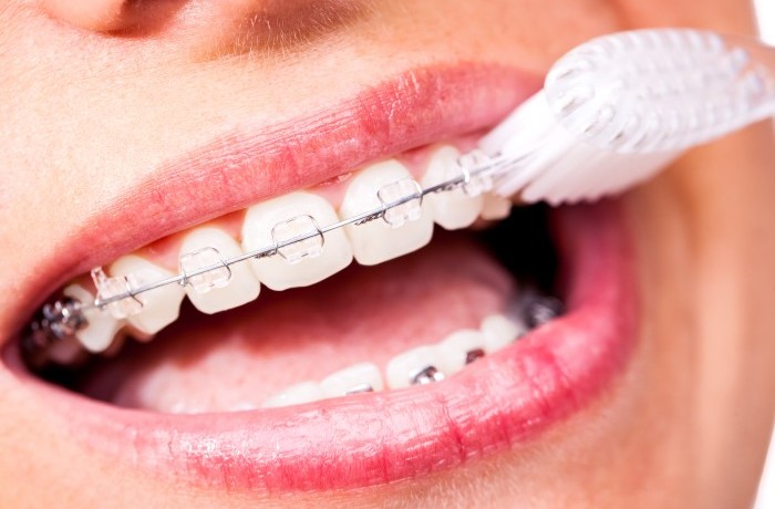 Taking care of your braces - Align Orthodontics : Align Orthodontics